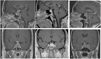 Atypical Teratoid Rhabdoid Tumor: A Possible Oriented Female Pathology?